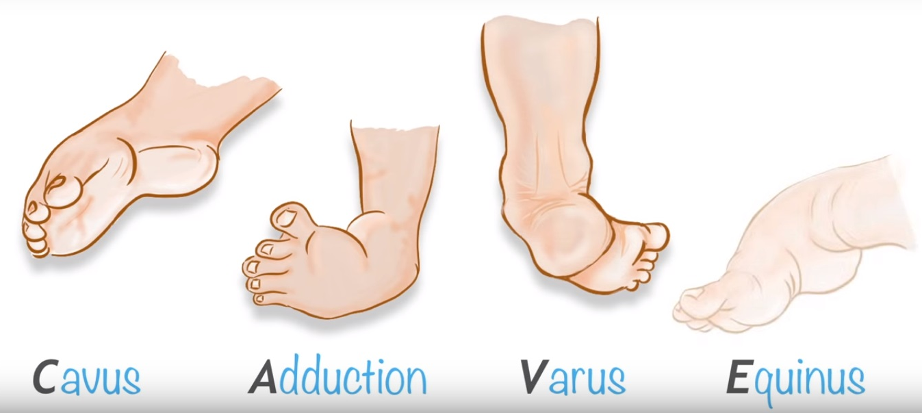 Ways to Treat Congenital Talipes Equinovarus Tips and Advice on